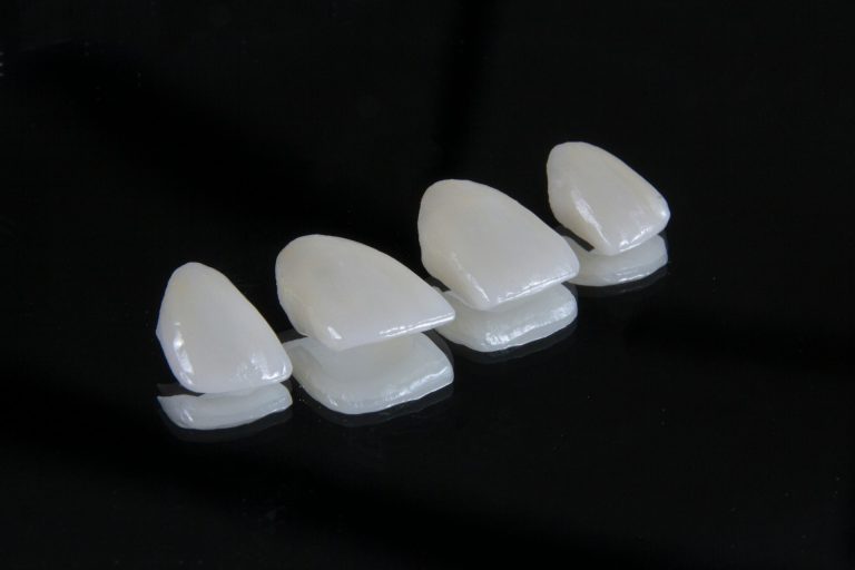 Veneers